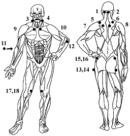 Fibromyalgia tender points